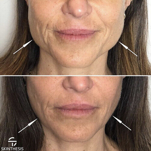 Botox in Jawline - Before And After Picture