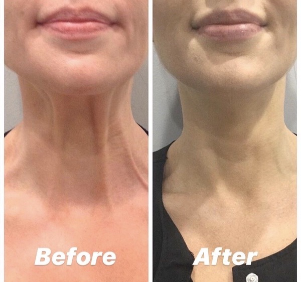 Neck Botox Before And After Picture