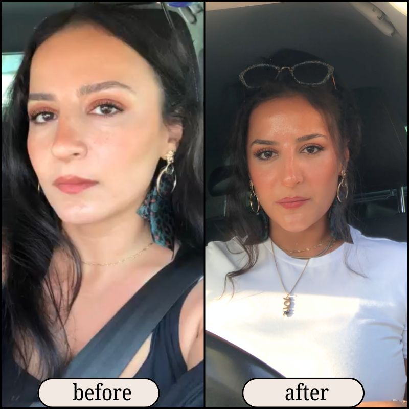 Chin Fillers Before and After