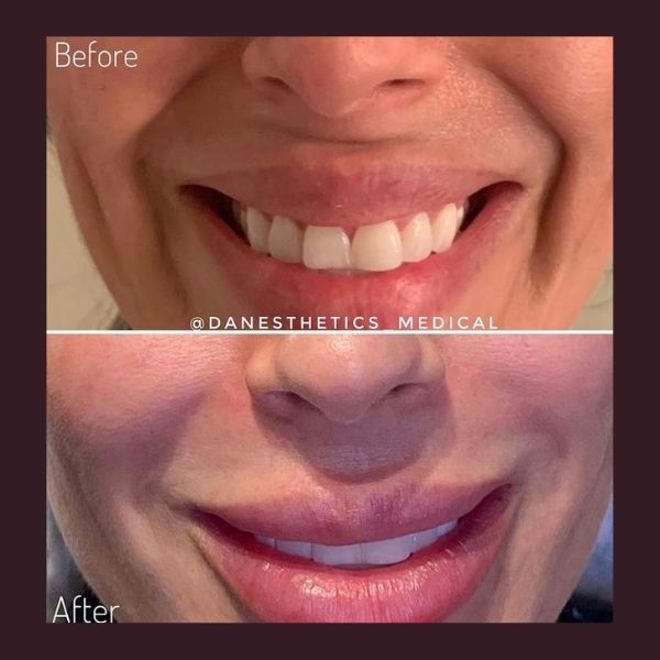 Fillers For Nasolabial Folds - Before and After