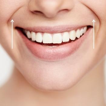 What are Smile Lines